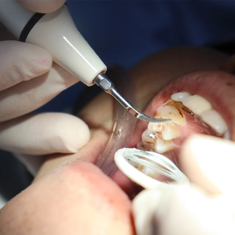 Cable de tubo de pieza de mano - Teeth Whitening Youtube reseña y precio