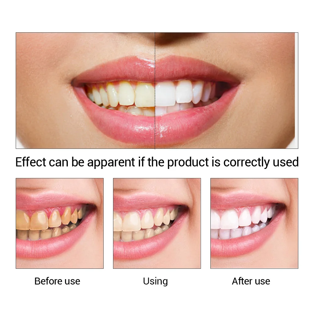 FTEENPLY-esencia para blanquea - Teeth Whitening Ai reseña y precio