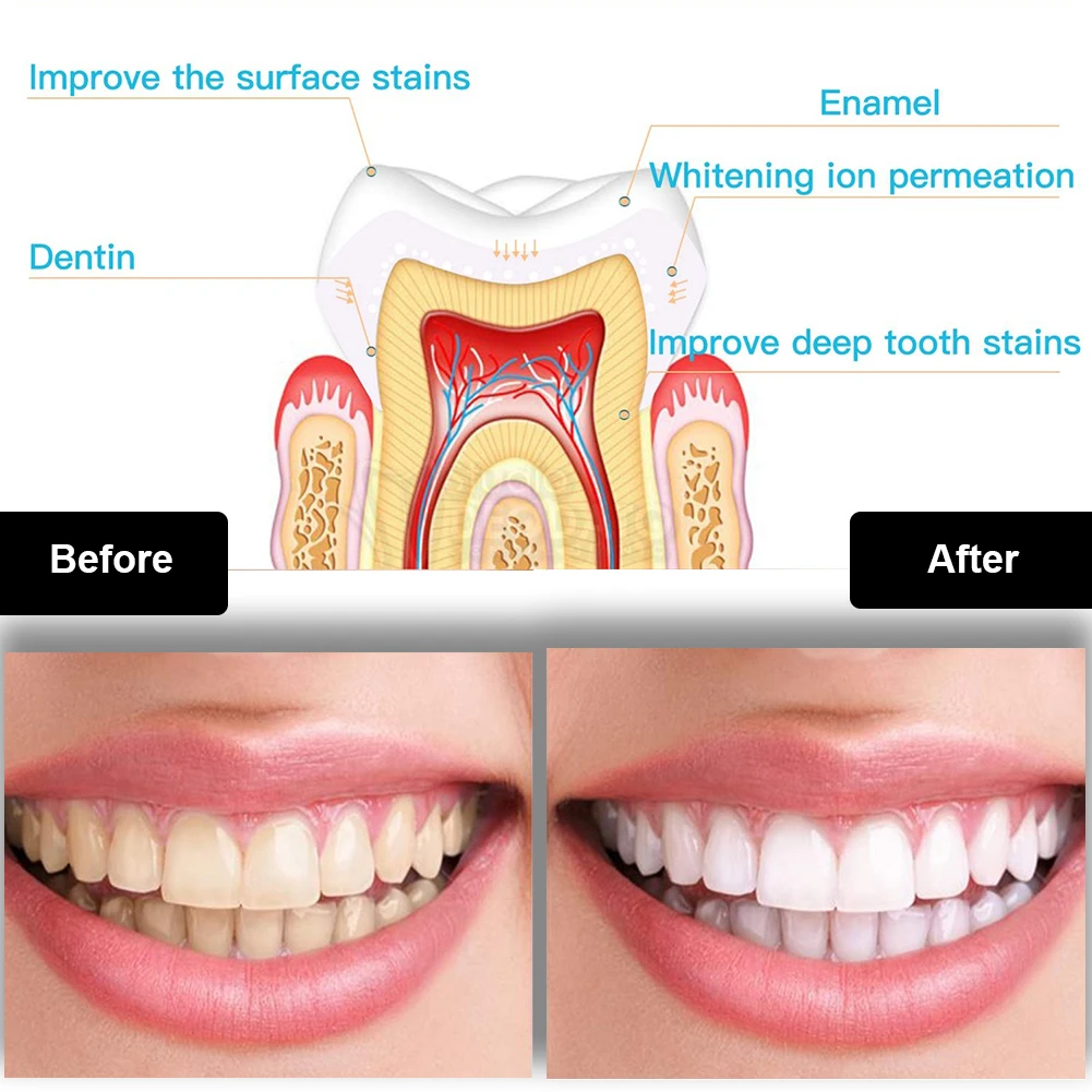 Kit de blanqueamiento Dental M - Teeth Whitening Ai reseña y precio